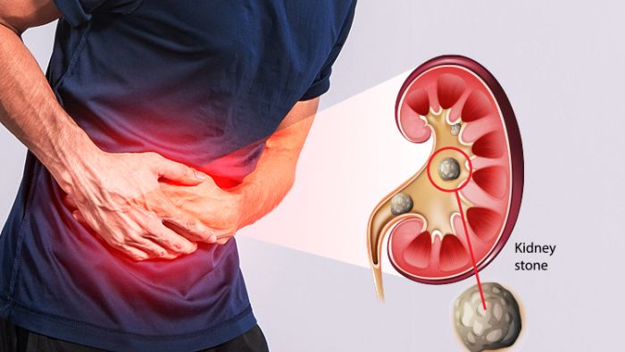 Kidney Stone Diet Gujarati